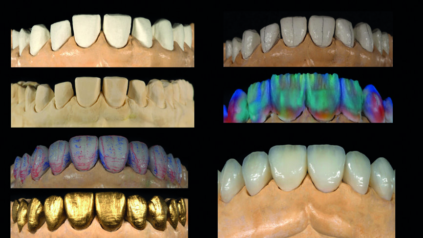 Fig. 13 : Flux de travail analogique (modèles positifs unitaires réfractaires, fabrication des facettes, ajustements, coloration/glaçage). 
