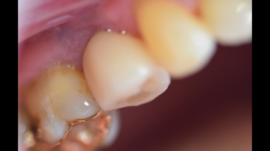  Nacementovaná korunka in situ