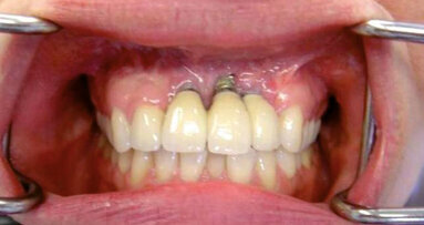 Profilassi di successo delle perimplantiti