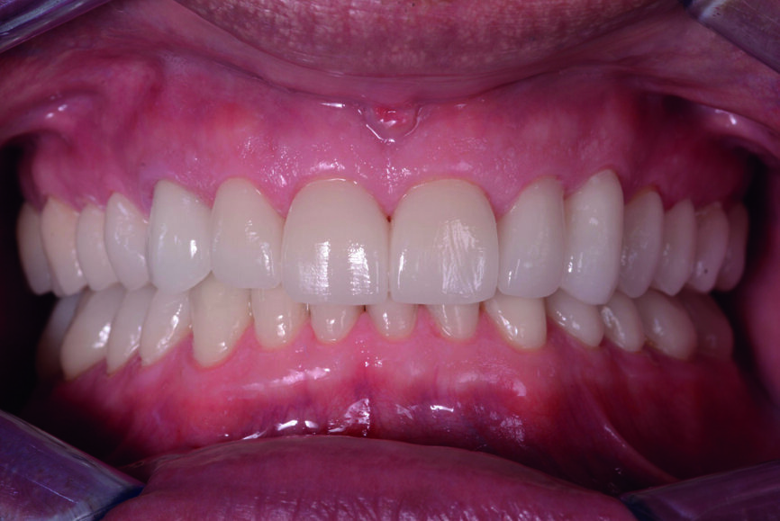 Figs. 13 et 14 : Photographies intraorales après le traitement. 