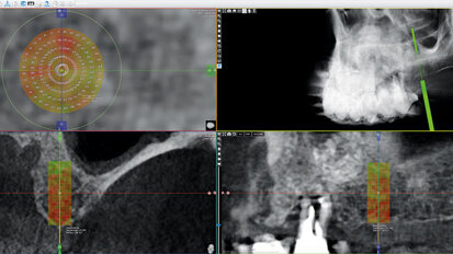 CBCT kostní denzitometrie pro rozhodování před chirurgickým zákrokem