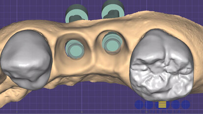Profili gengivali in protesi: approccio full-digital