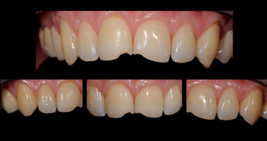 Ästhetisch-funktionelle Veneers bei habituellen Dysfunktionen?