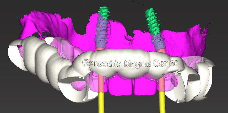 Fig. 16 - Disegno dima chirurgica.