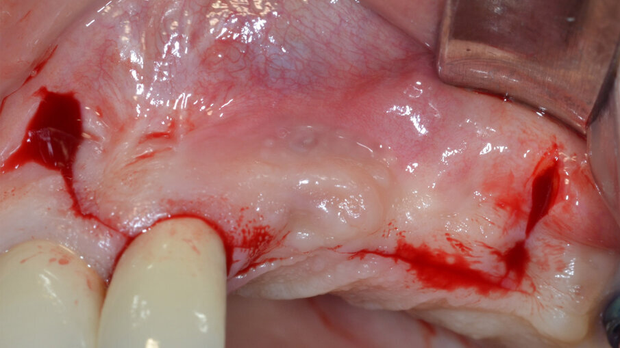 Fig. 3 - Elevazione di un lembo di accesso a spessore totale.