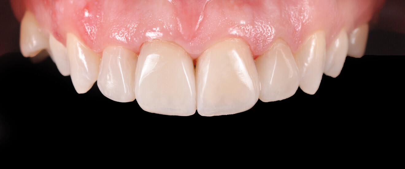 Fig. 21: Close-up of the treatment outcome, showing the mamelons and natural incisal translucencies.