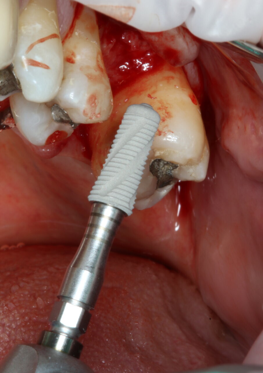 Fig. 4_Inserimento dell’impianto (AoN SLC con connessione Revcon).