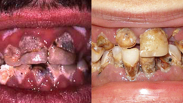 Soda and illegal drugs cause similar damage to teeth