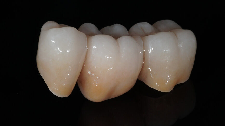 Fig. 9: Appearance of the bridge after individualisation with CERABIEN ZR FC Paste Stain. 