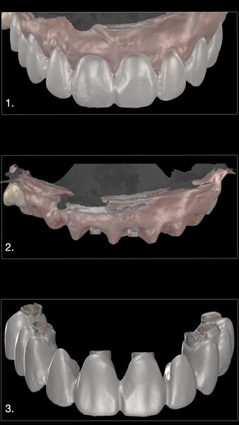 Fig. 26: Digital impression.