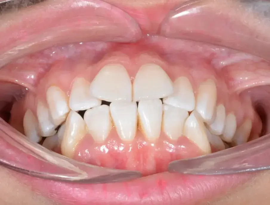 Фиг. 3b: Първоначални оклузални изображения.