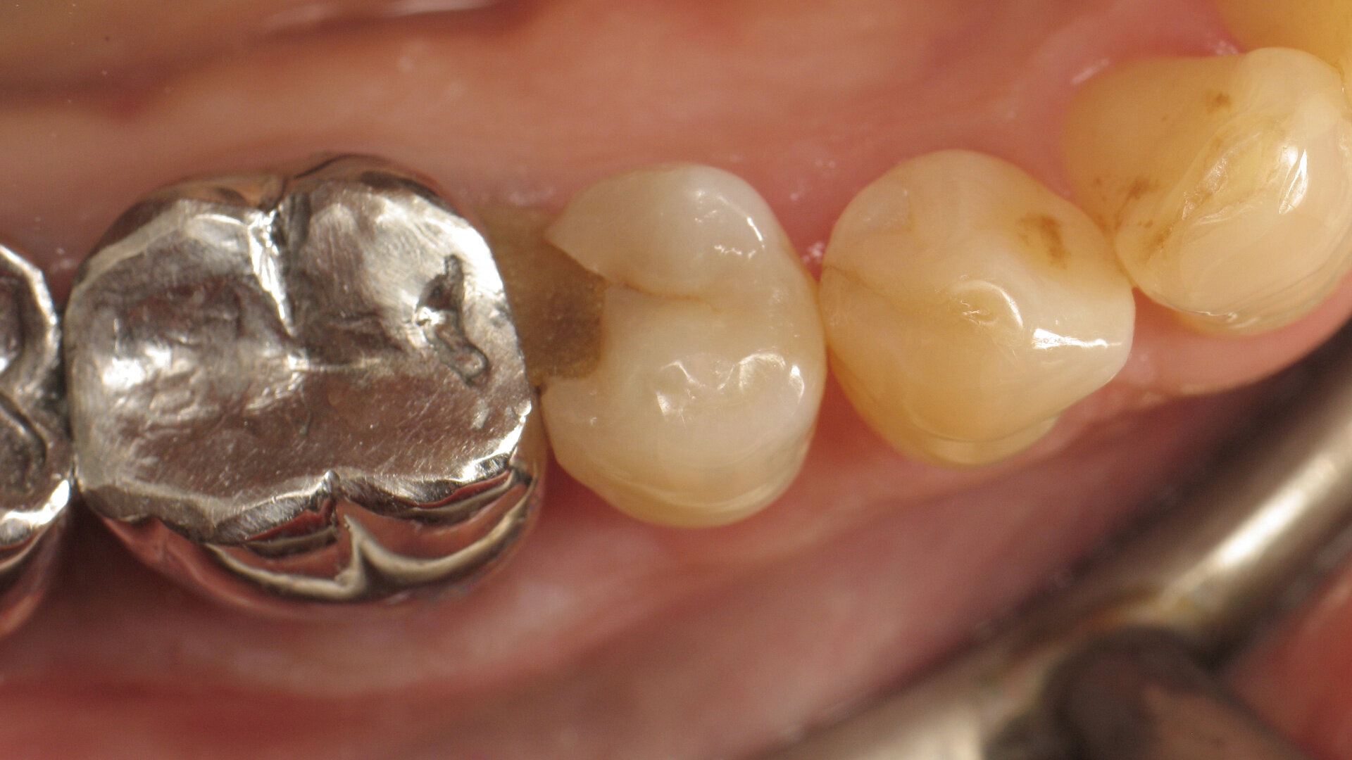 Restauration de classe II avec du composite thermo visqueux