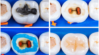 Całkowity zakaz stosowania wypełnień amalgamatowych