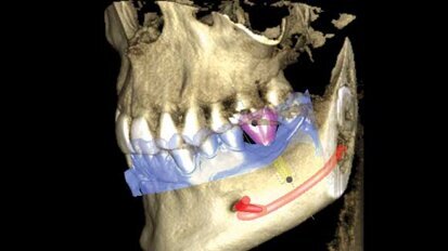 Restorative-driven implant therapy Restorative-driven implant therapy