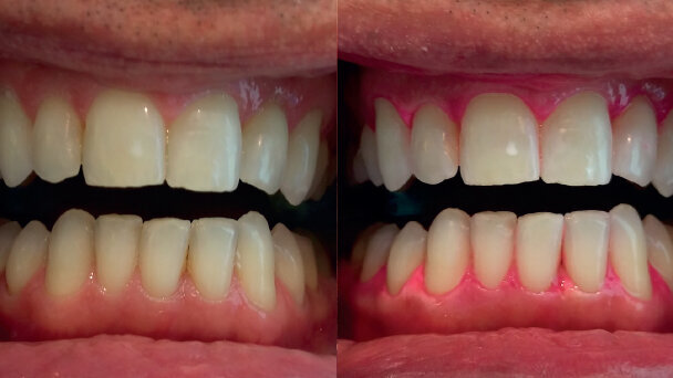 Analisi dei risultati ottenuti con un trattamento sbiancante post igiene