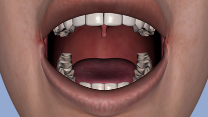 Rekonstruierter Oberkiefer aus dem 3-D-Drucker
