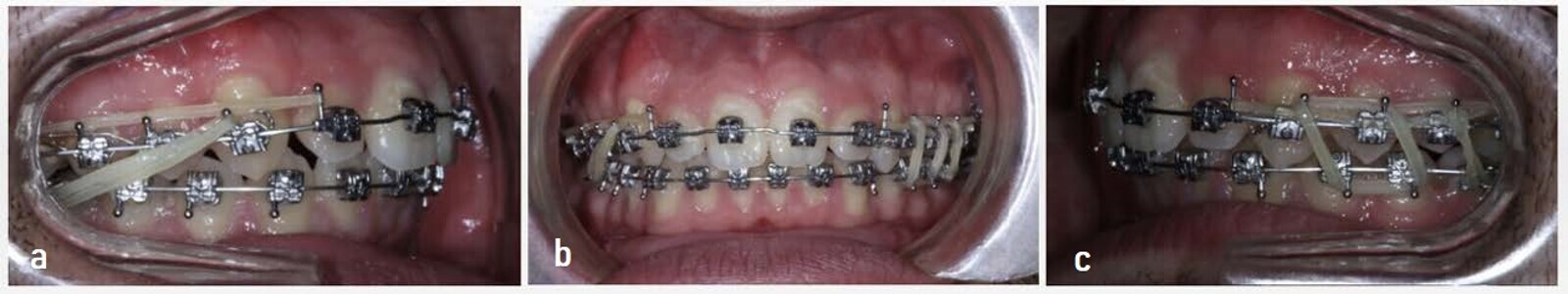 Figs. 14a–c: Class II elastics and posterior box elastics to correct occlusion in both arches. Crimpable hooks distal to each maxillary lateral incisor. 