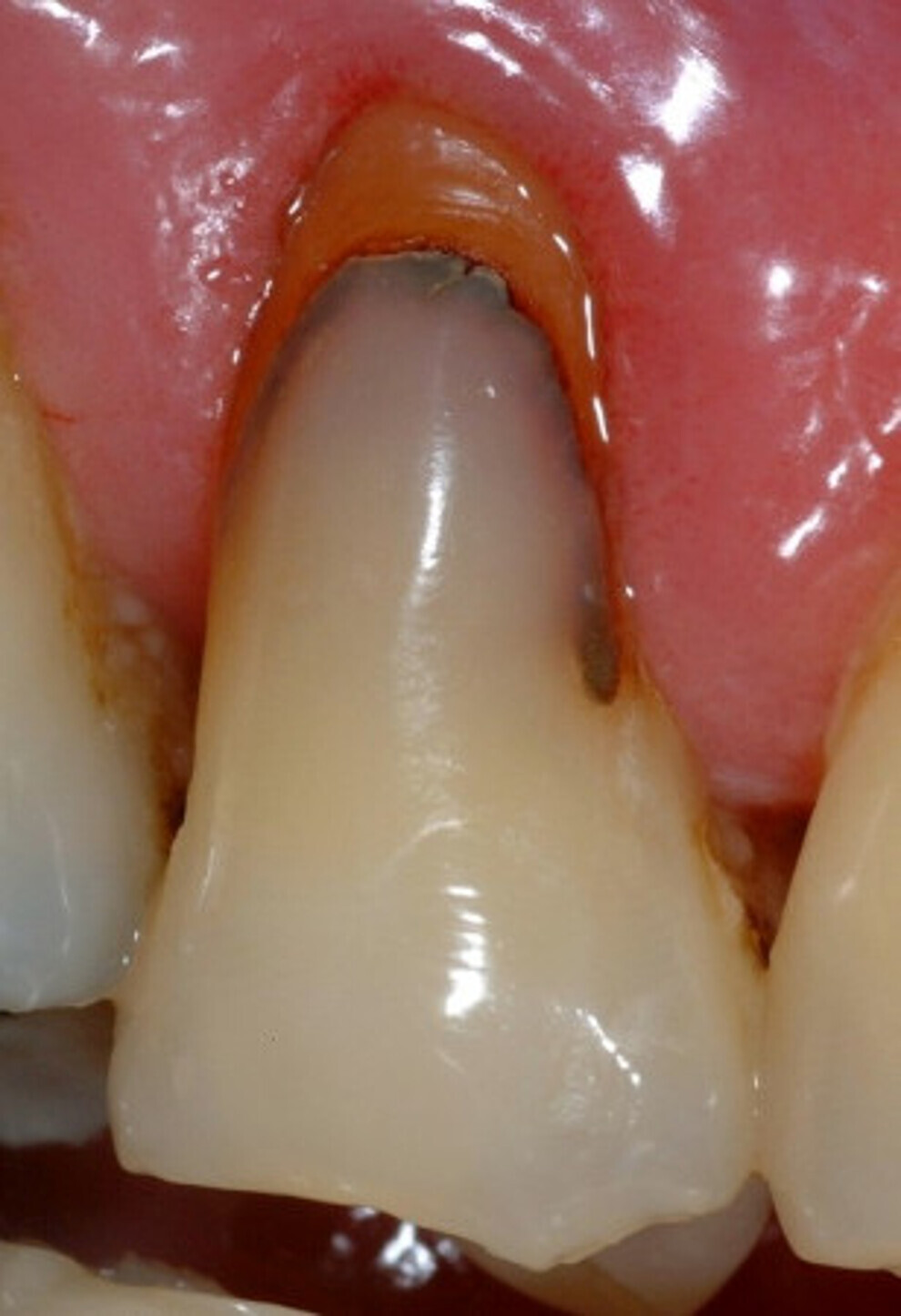 Fig. 2 : Malgré leurs excellentes propriétés, la mise en place des résines composites est techniquement plus exigeante (Avec l’aimable autorisation du Pr B. Van Meerbeek, université catholique (KU) de Louvain – BIOMAT, Belgique).plus influents).