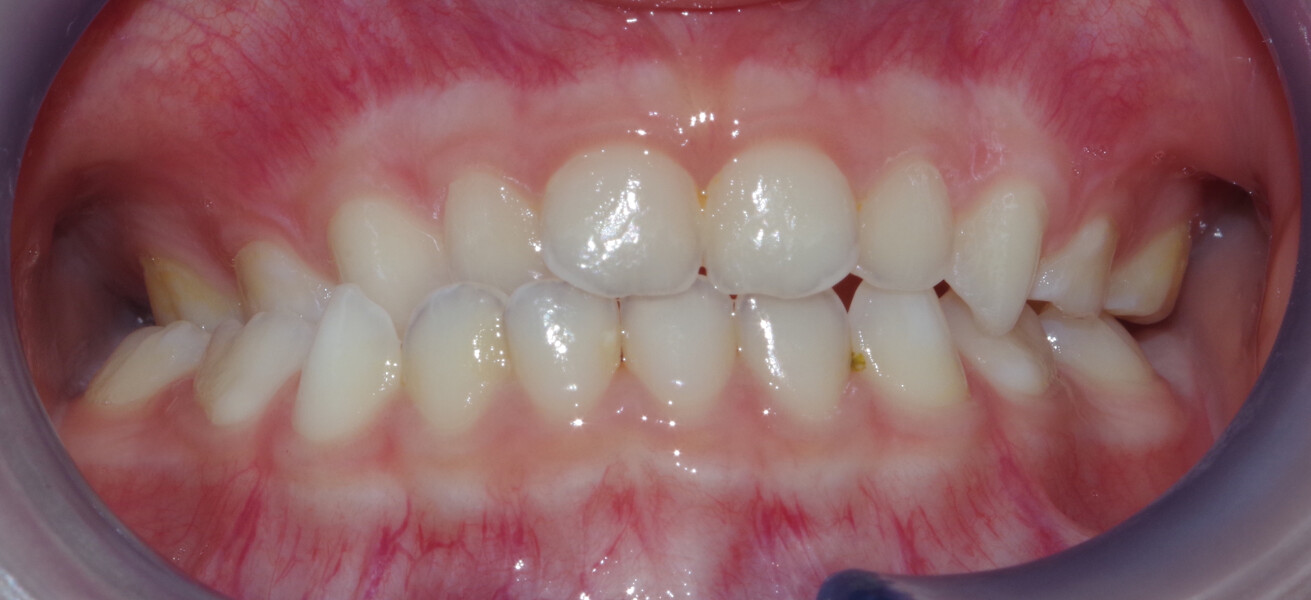 Fig. 13b: Initial intra-oral photograph: frontal view.