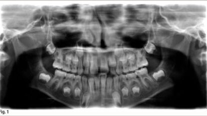 Le futur de l'endodontie : la revascularisation pulpaire