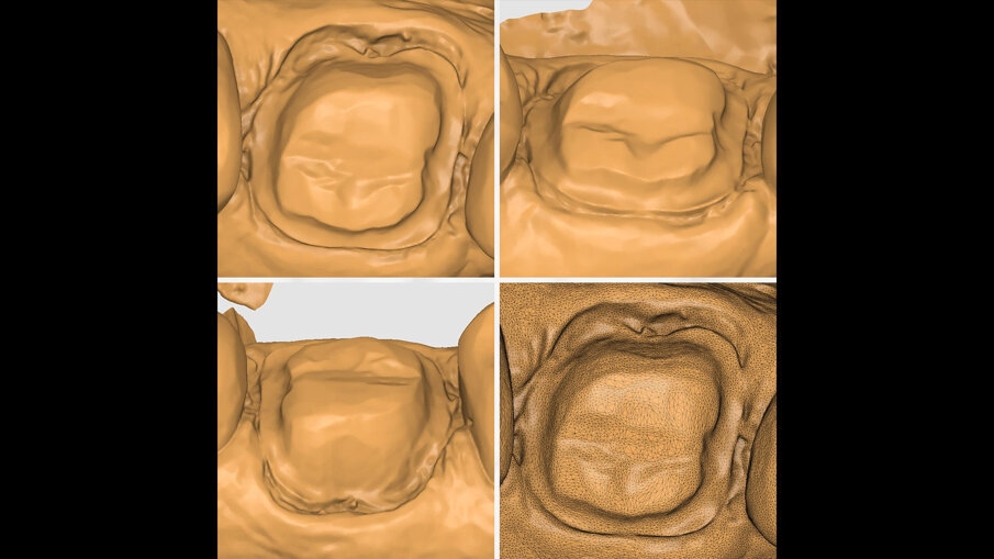 Fig. 10 - Scansione dei margini di preparazione con CEREC Primescan. 