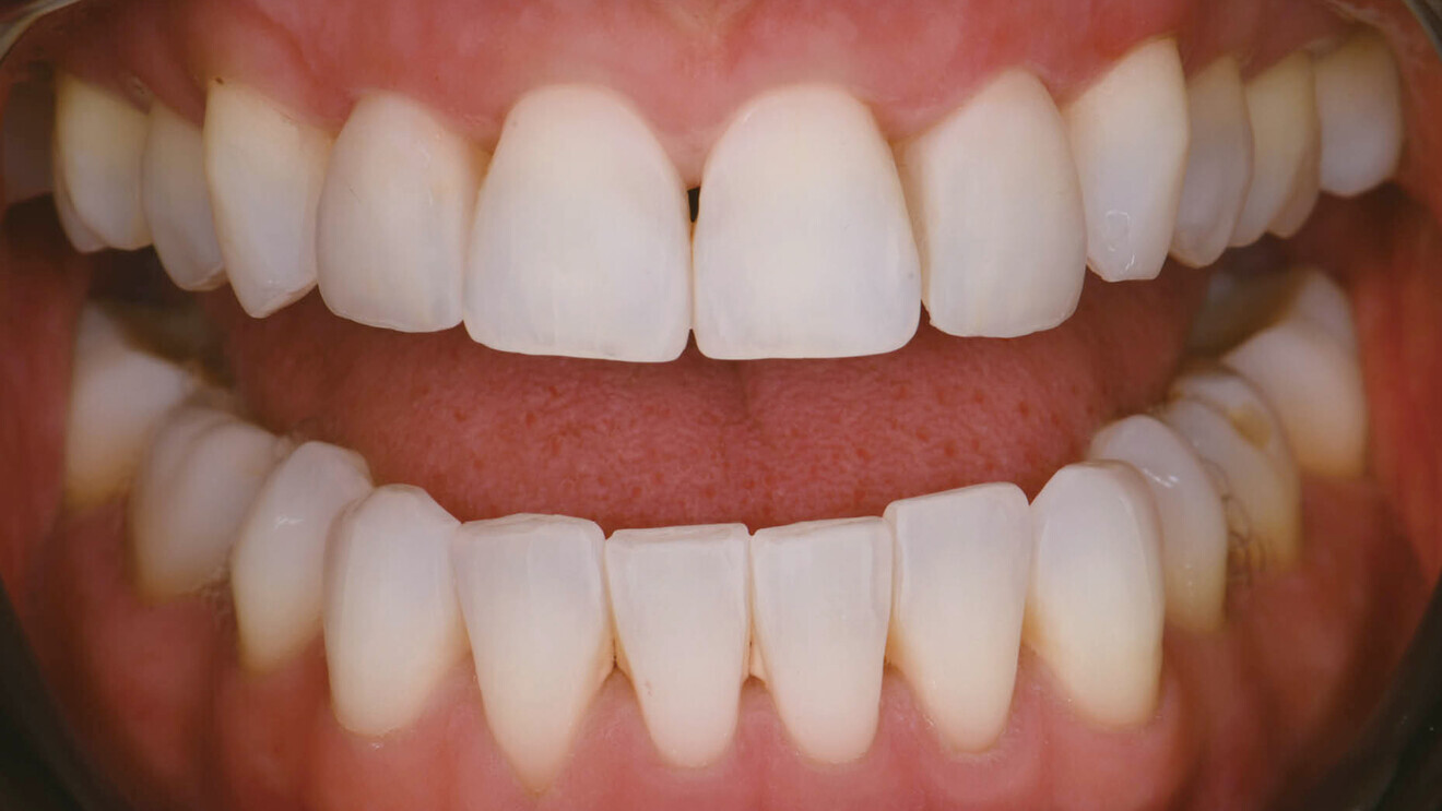 Fig. 10: Final result with polarised photography on reassessment.