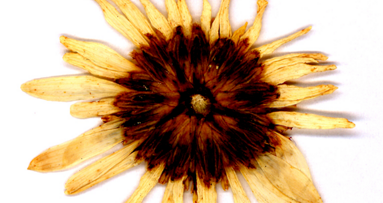 Legame tra infiammazione delle gengive e Alzheimer