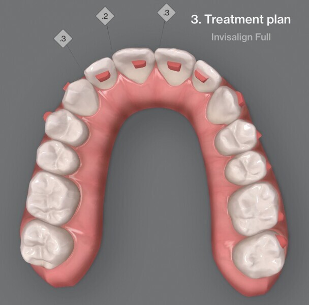 Fig. 4a : Premier résultat prévu par simulation ClinCheck.