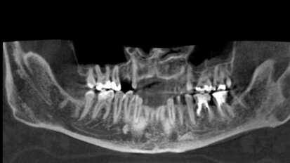 Występowanie dwudzielnego kanału żuchwy – przegląd piśmiennictwa