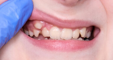 LightForce Orthodontics secures funding for 3D‑printed brackets