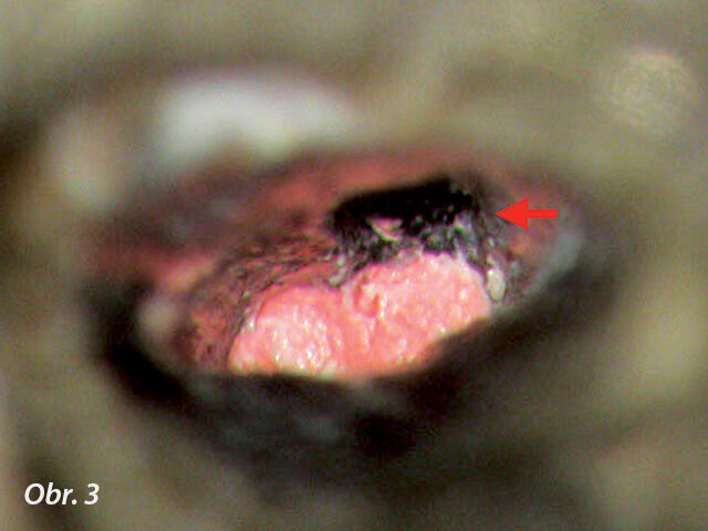 Hluboké rozvětvení kanálku. Vyplnění prvního kanálku kontrolované pod mikroskopem těsně pod místo lomu (šipka).