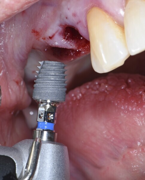 Fig. 2: Implant placement. 