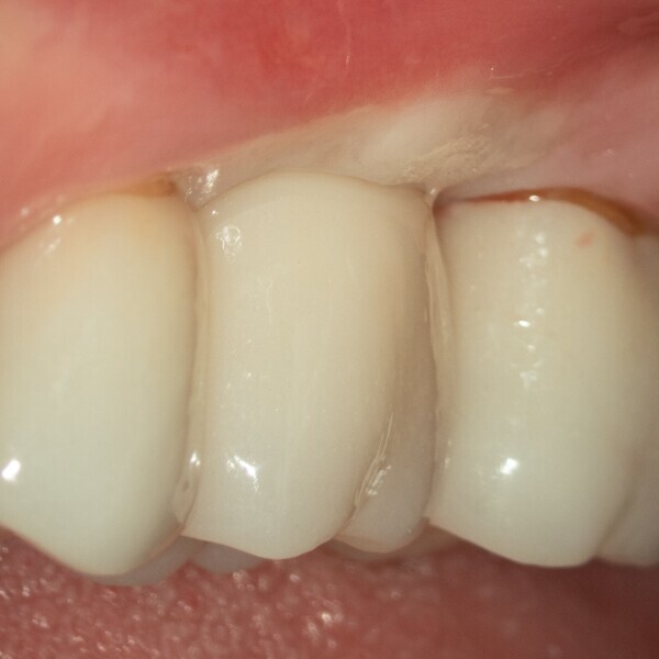 Fig. 2c: Buccal view of the marginal gingiva at prosthesis delivery. Note the gingival bleaching due to compression by the crown.