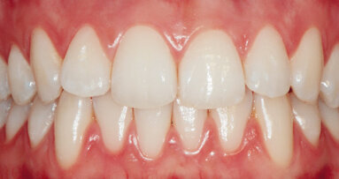 Riabilitazione estetica e funzionale dei settori posteriori con tecnica diretta e indiretta