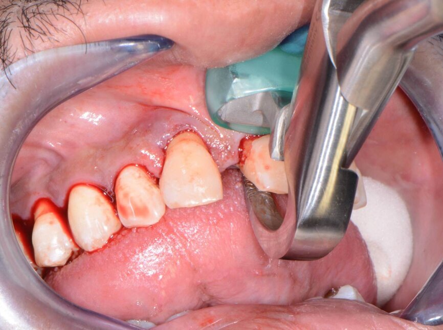 Fig. 6: Physics Forceps used for extractions.