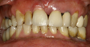 L’utilizzo di monconi in  zirconio per il miglioramento  dell’estetica rosa