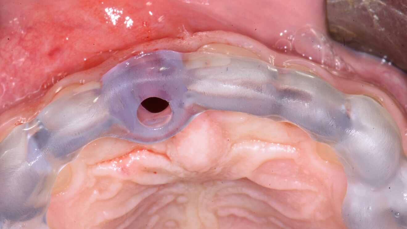 Fig. 6: Surgical guide in situ.