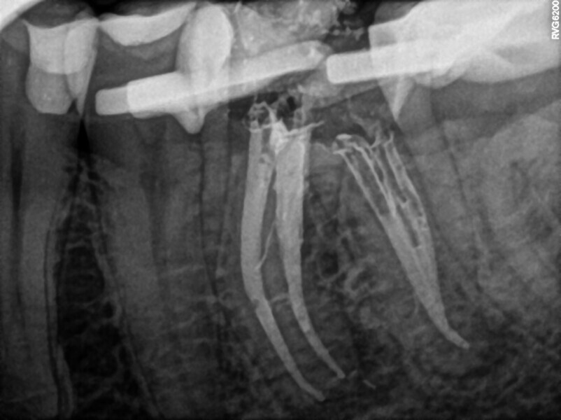 Fig. 38: Post-op radiograph.