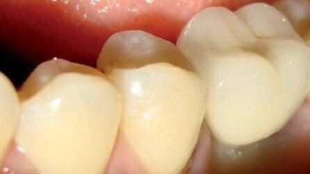 Rekonstrukcja implantoprotetyczna pierwszych trzonowców w żuchwie z wykorzystaniem systemu BEGO Semados®