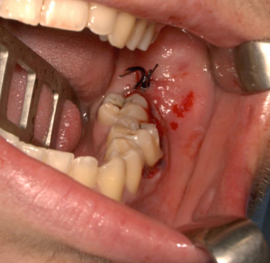 Fig. 13_Sutura a punti staccati in seta.