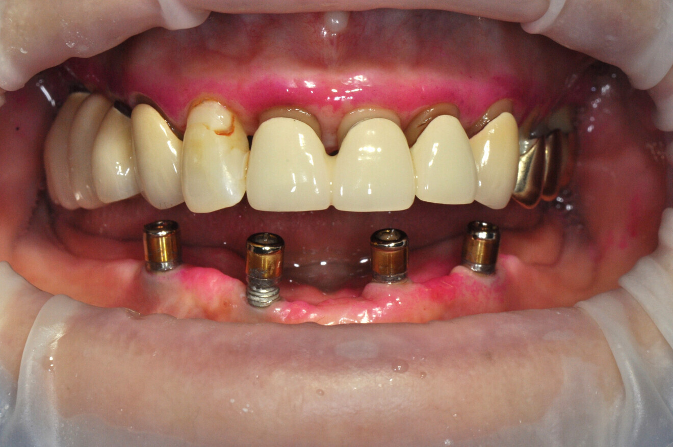 After Guided Biofilm Therapy using AIRFLOW MAX.