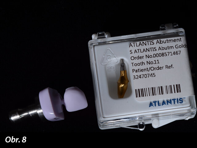 Abutment Atlantis a dříve vyfrézovaná e.max korunka.
