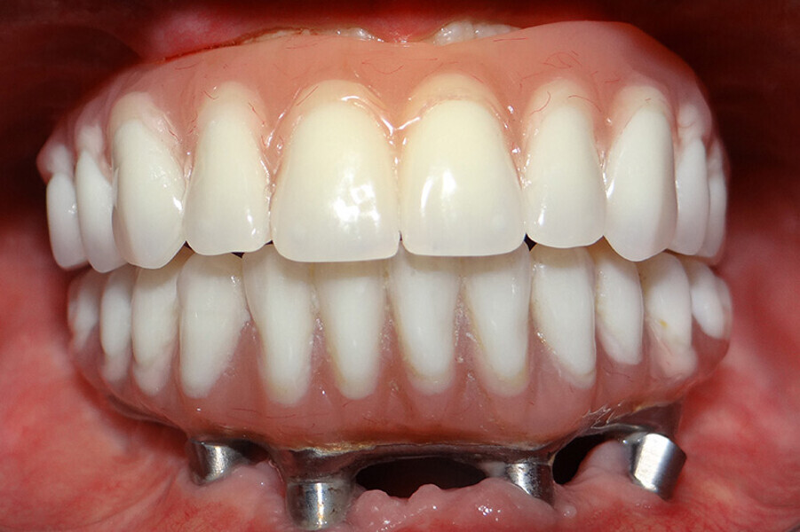 Fig. 17. Rx Pre-operatoria, Prótesis híbrida inmediata con 6 años de evolución y Rx Control a los 6 años.