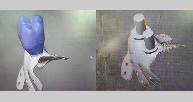 Cierre de comunicación oro-sinusal con placa de titanio personalizada 3D