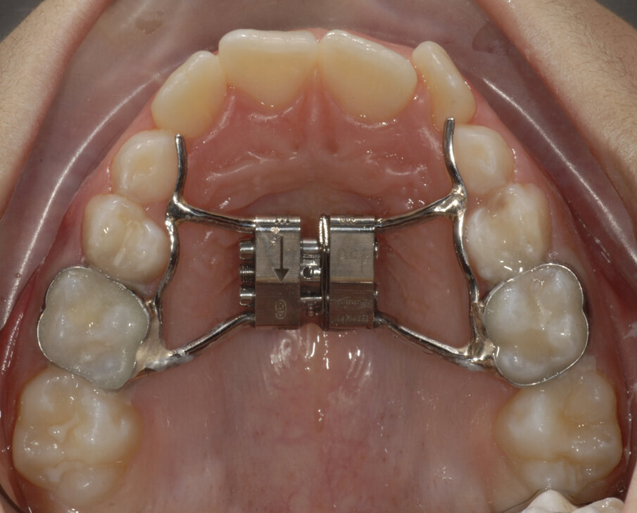 Fig. 14_Leaf expander cementato.