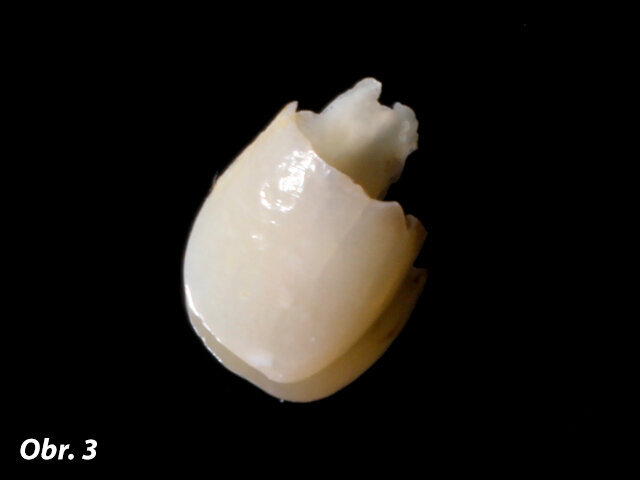 Obr. 3: Extrahovaný zubní fragment