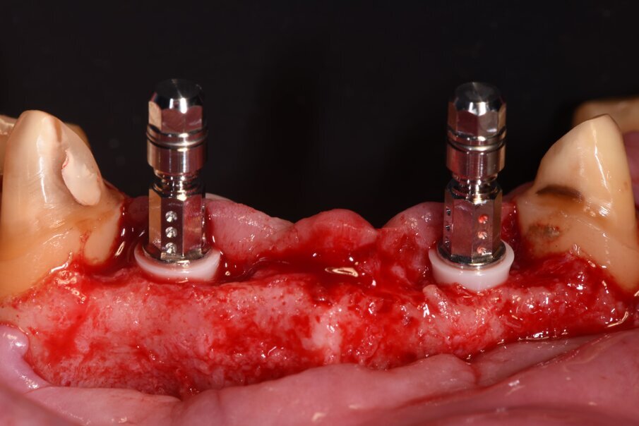 Fig. 21_Il posizionamento non prevede l’uso della dima e in quest’immagine si evidenzia il livello d’inserimento che ha tenuto presente il livello crestale palatale, i mounter evidenziano il parallelismo ottenuto grazie al meticoloso lavoro sommato alla conoscenza della tecnica chirurgica.