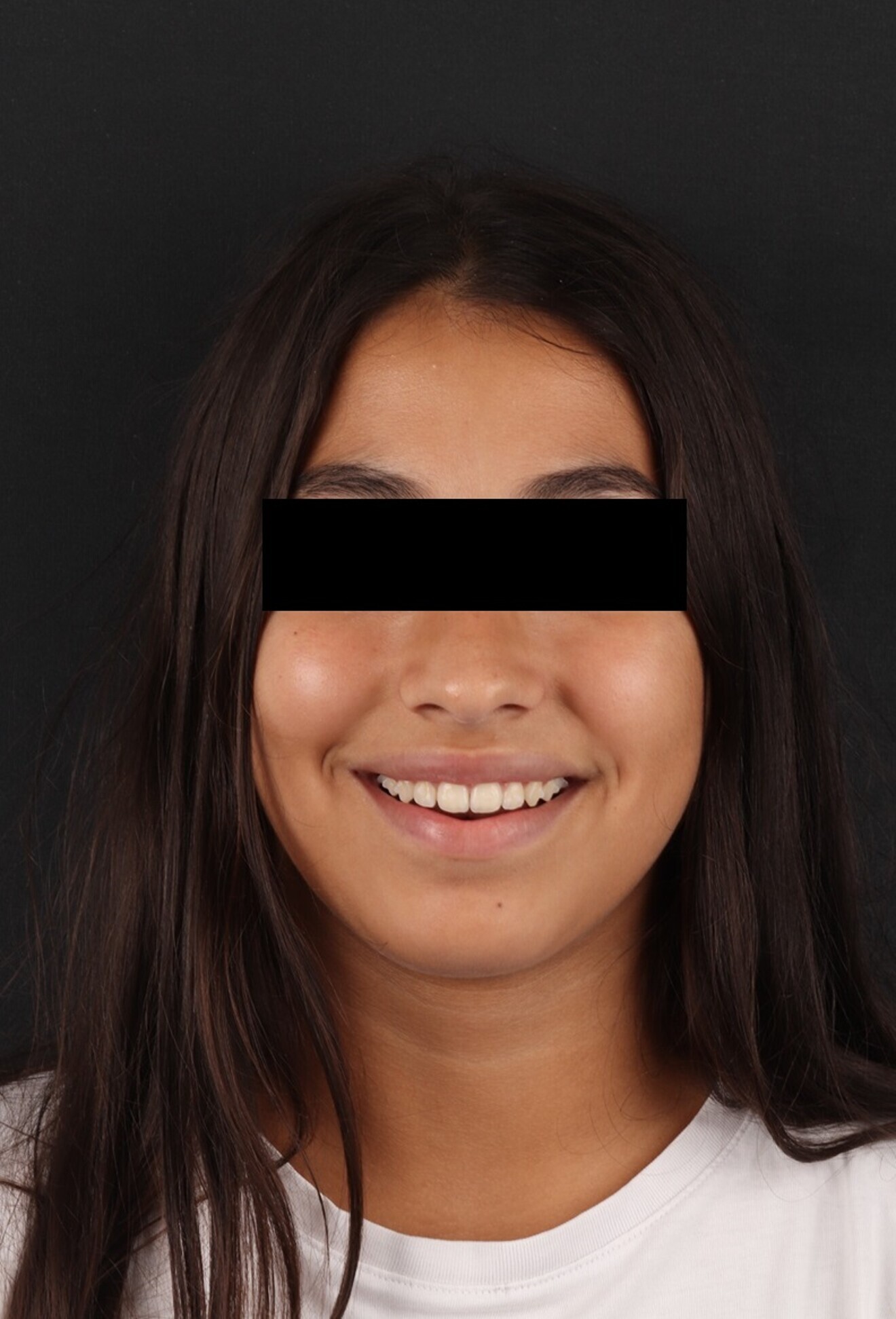 Fig. 28: Extra-oral clinical photograph showing the patient’s smile after treatment.