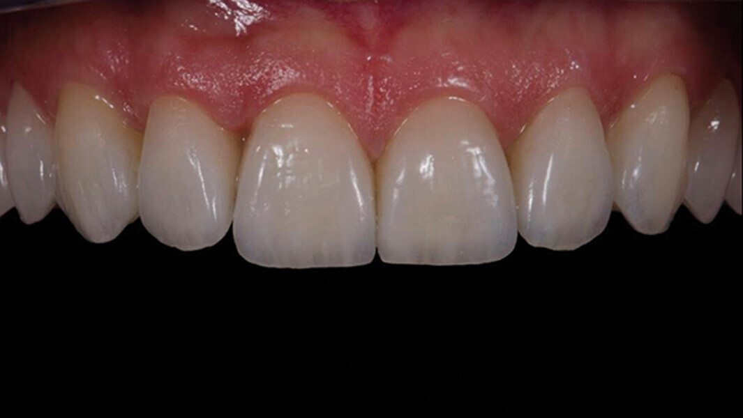 Fig. 15a. Carillas feldespáticas con pasta de prueba.