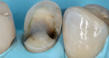 Les restaurations partielles collées postérieures en céramique – le point de vue du Québec